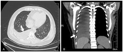 Krukenberg tumor arising from gastric cancer presenting as Pseudo-Meigs' syndrome: a case report and literature review